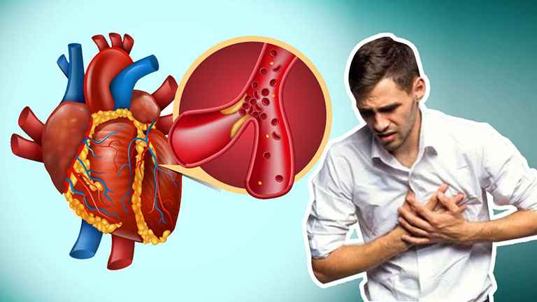 Nh&ocirc;̀i máu cơ tim khác với ngưng tim đ&ocirc;̣t ng&ocirc;̣t (SCA)
