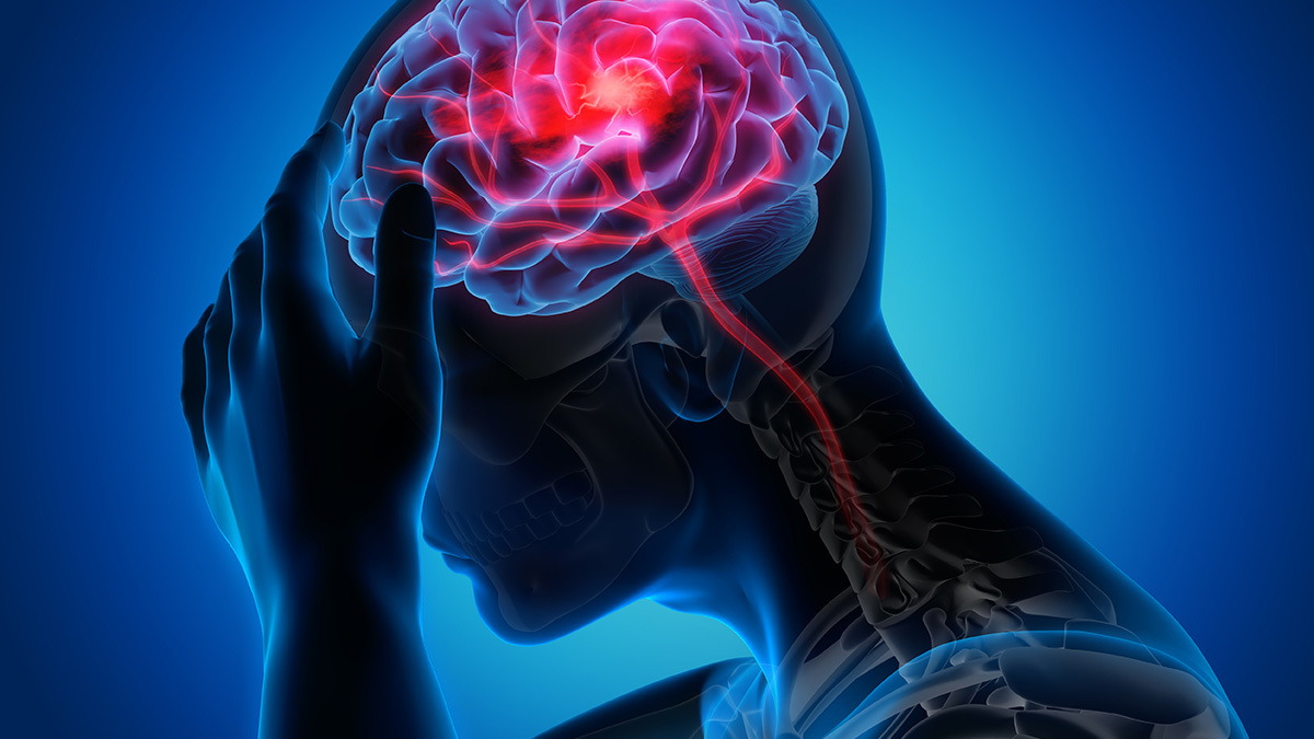  Tắc nghẽn mạch máu não hoặc vỡ mạch máu não là nguy&ecirc;n nh&acirc;n chính d&acirc;̃n đ&ecirc;́n đ&ocirc;̣t quỵ (Stroke).